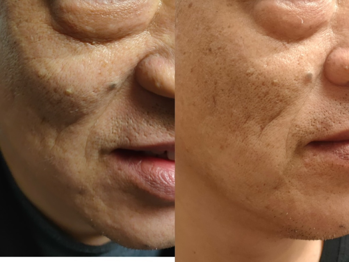 用户反馈照片:案例 5,同一张照片内为使用前与使用后对比。